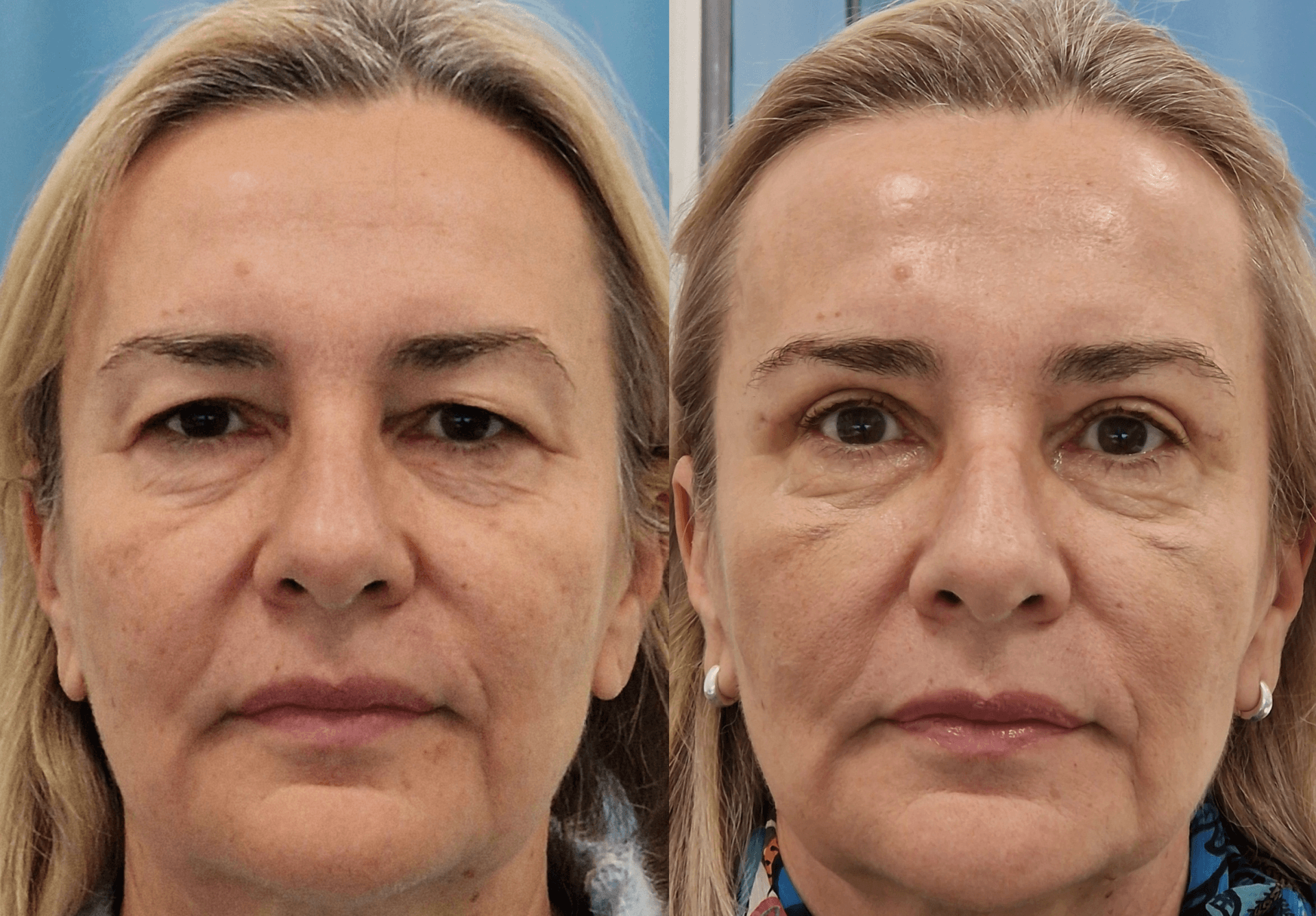 18. Upper eyelid_before and after