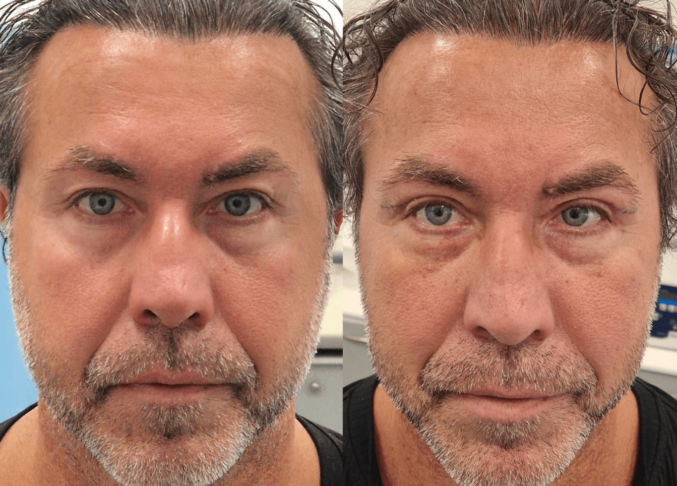 14. Upper eyelid_before and after małe