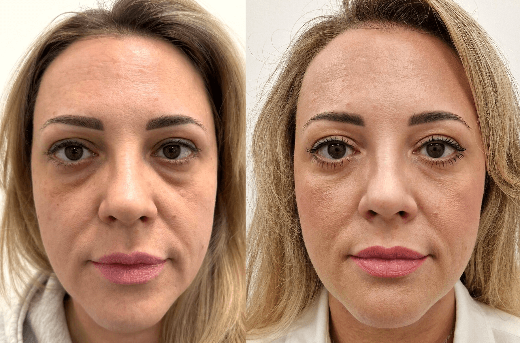 13. lower euelid before and after