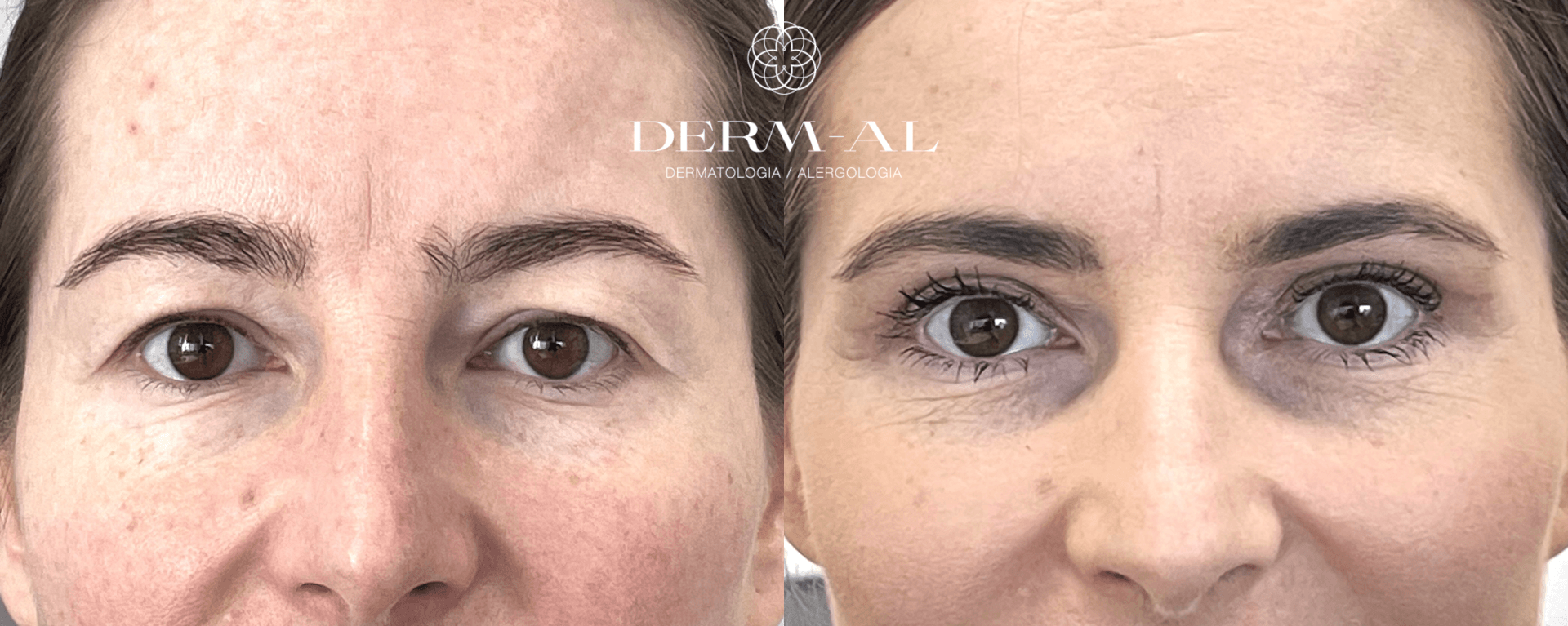 9. Upper eyelid_before and after