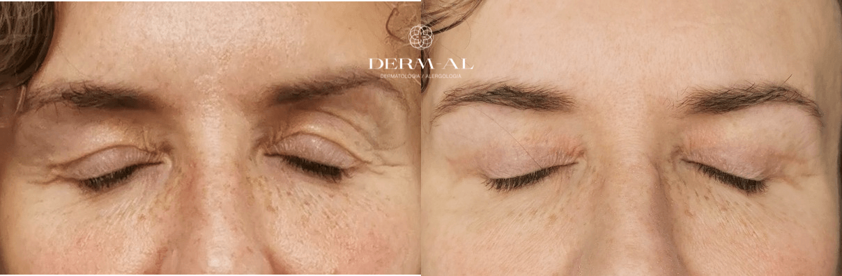 6. chirurgiczna korekcja powiek górnych_przed i po