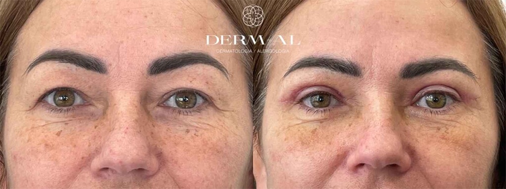 plastyka-powiek-gornych-po-7-dniach-po-zdjeciu-szwow