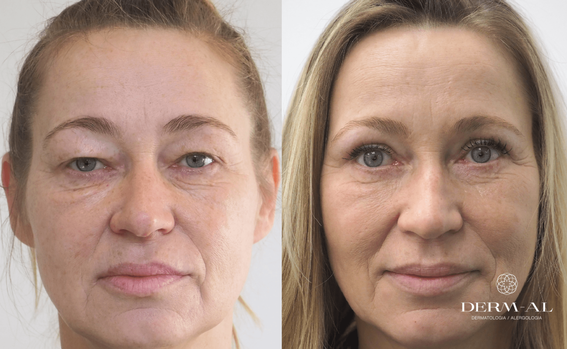 1. Upper eyelid_before and after