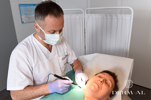 elektrokoagulacja_dermatologia
